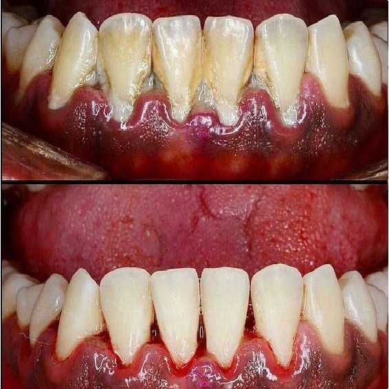 Full Mouth Scaling & Polishing Treatment Ajmer
