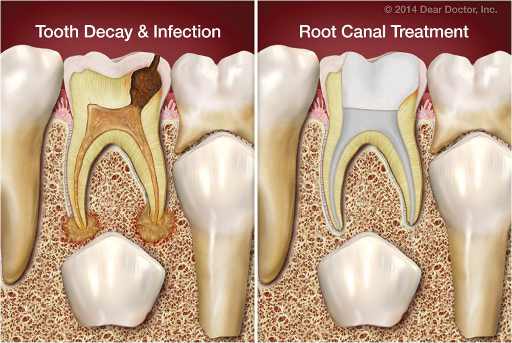 Kids Root Canal Treatment Ajmer