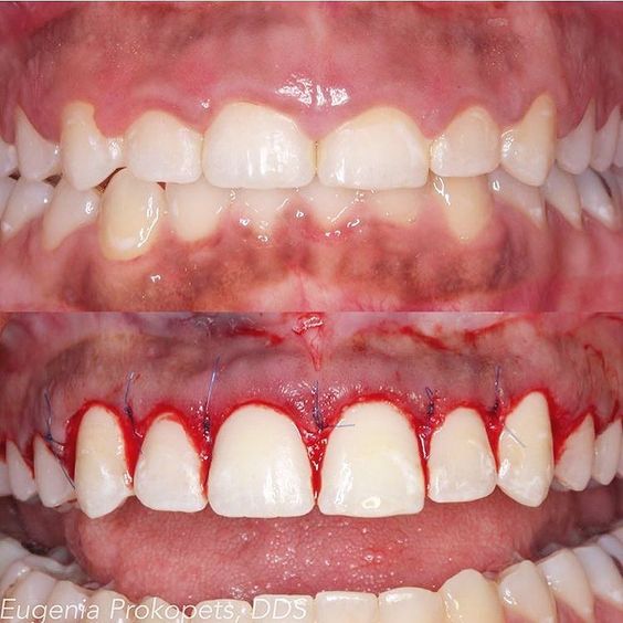 Laser Gummy Smile Correction Treatment Ajmer