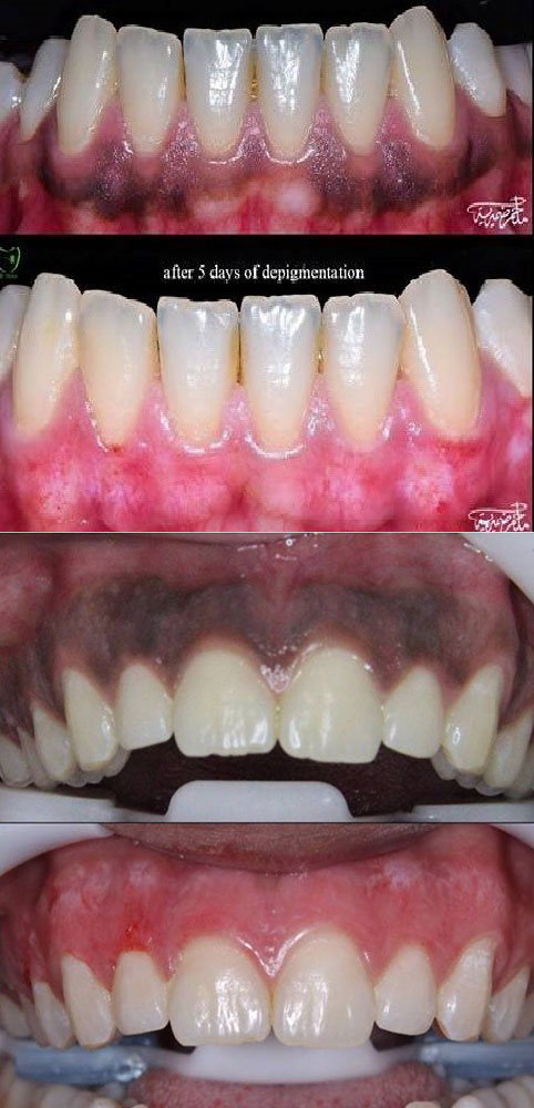 Laser Gums De Pigmentation Treatment Ajmer