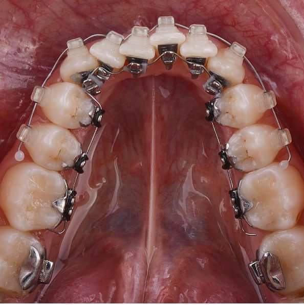 Lingual Braces Treatment Ajmer