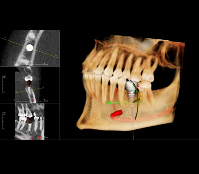Nobel Guide Computer Guided Surgery Treatment Ajmer