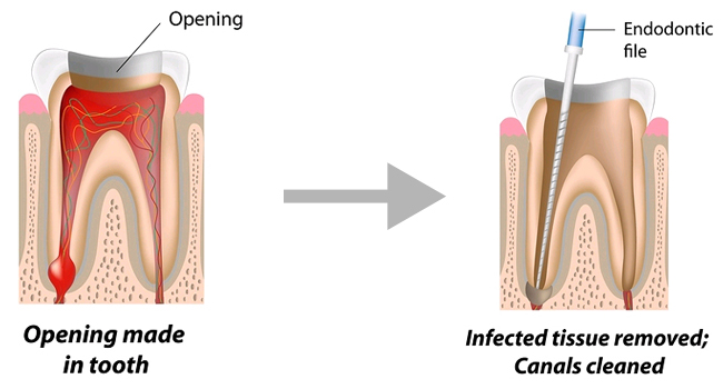 Painless Microscope Assisted (RCT) Treatment Ajmer