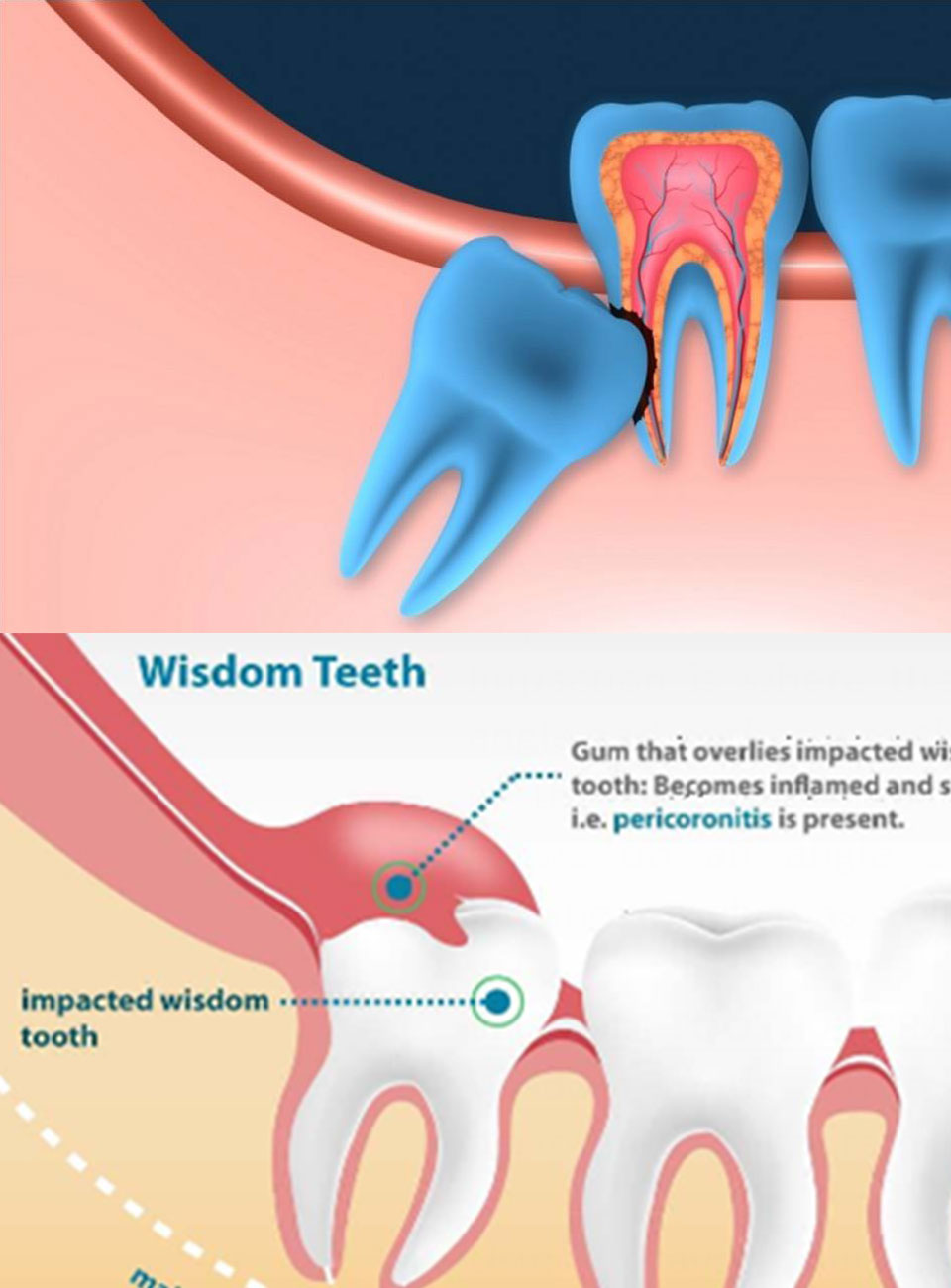 Simple & Surgical Extractions Treatment Ajmer
