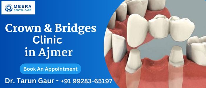 Crown & Bridges Treatment in Ajmer