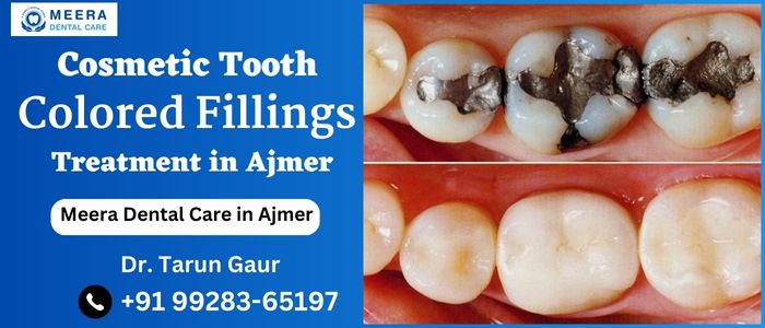 Cosmetic Tooth Colored Fillings Treatment Ajmer